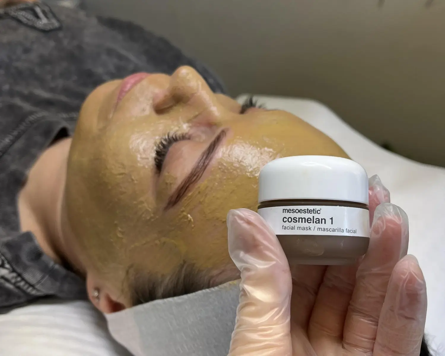 tratamiento Cosmelan en Madrid