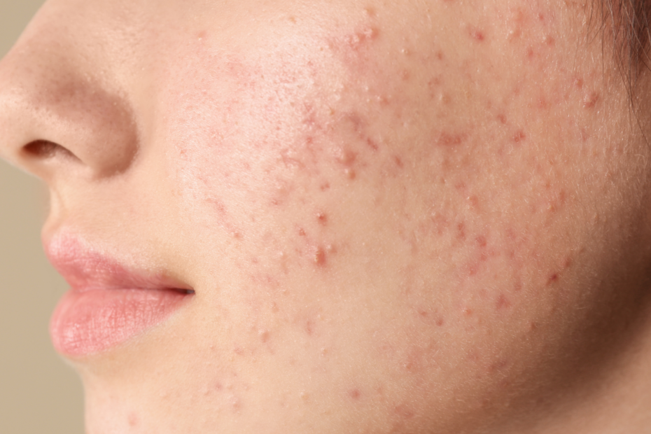 Acné en adolescentes