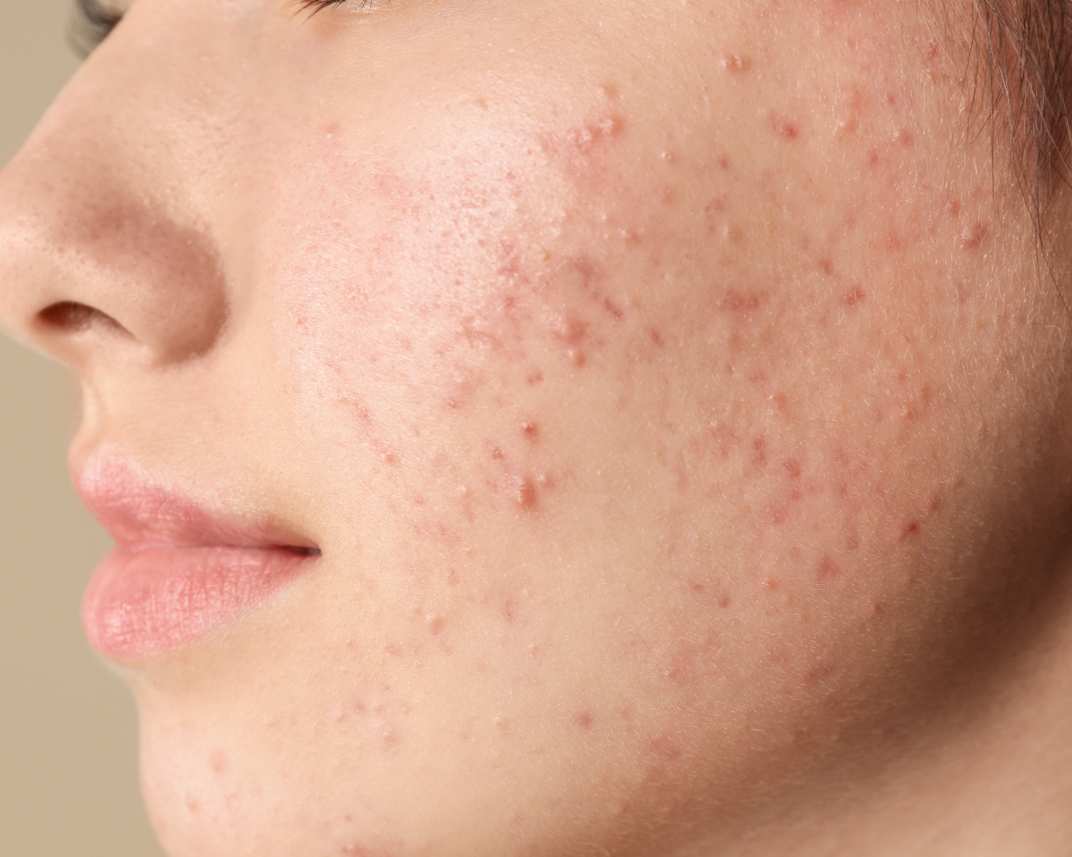 Acné en adolescentes