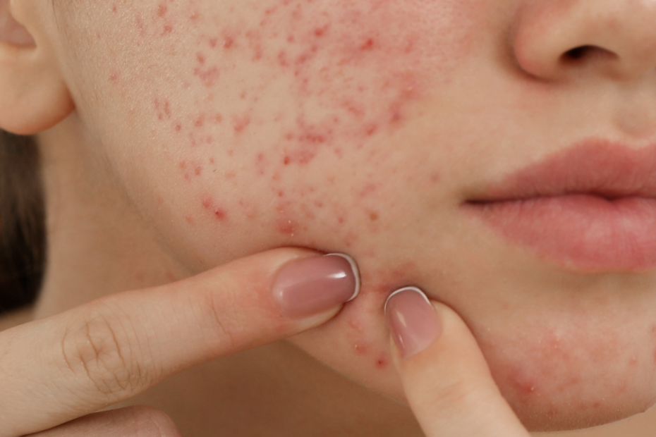 errores comunes en acné adolescentes