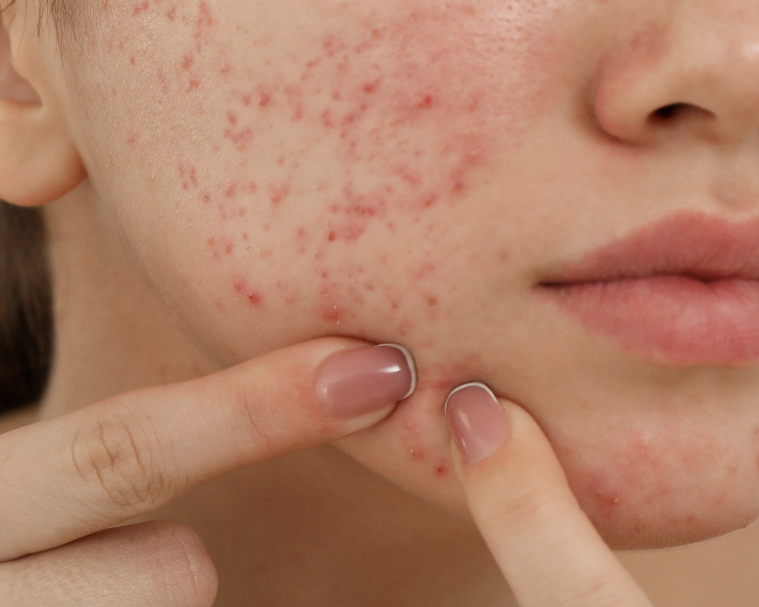 errores comunes en acné adolescentes